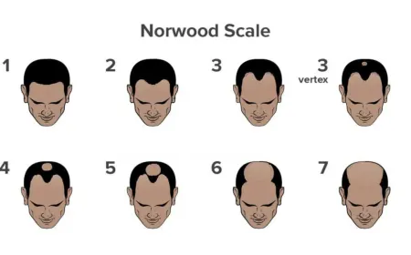 What is Causing Your Hair Fall? Take This Scientifically Backed Hair Loss Quiz